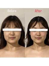 ハイコガオ(HIKOGAO)/小顔矯正40分