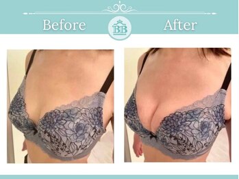 美人バスト 本厚木店/バストアップ◇症例◇