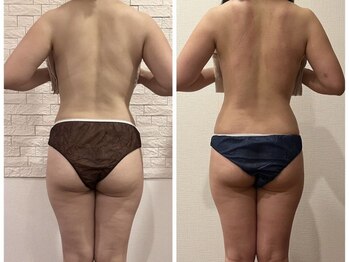 うつくし痩身 美サロン ゼットワン(Z-ONE)の写真/【体質を整える《筋膜リリース×痩身》】たぷたぷ二の腕を撃退♪華奢見せ上半身メディセル50分¥5800