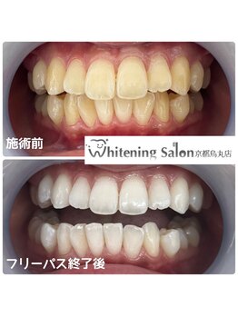 ホワイトニングサロン 京都烏丸店/ホワイトニング施術後