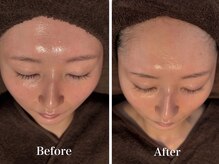 ボヌールデソワ(Bonheur de Soi)/ハーブピーリング/ニキビ/北堀江