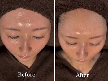 ボヌールデソワ(Bonheur de Soi)/ハーブピーリング/ニキビ/北堀江