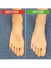 フォーツー 荻窪店(42)/脱毛　足の甲のビフォーアフター