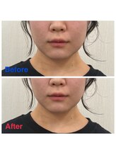 いおり鍼灸接骨院/美容鍼 Before→After