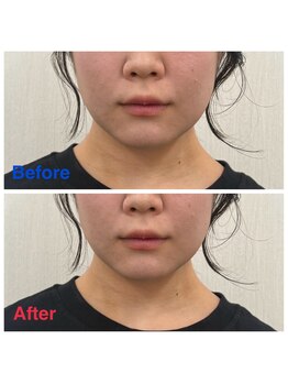 いおり鍼灸接骨院/美容鍼 Before→After
