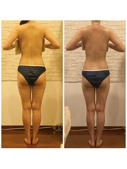 うつくし痩身 美サロン ゼットワン(Z-ONE)/メディセルbefore　afteｒ