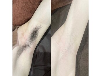 ルーチェ/【脱毛箇所】ワキ/3回照射