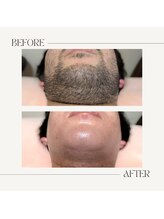 スプランドゥール(Splendeur)/メンズ【ひげ】WAX+光