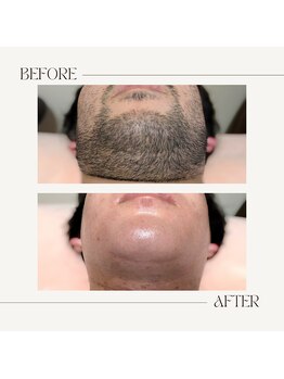 スプランドゥール(Splendeur)/メンズ【ひげ】WAX+光