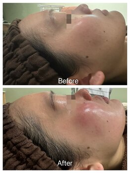 アトリエール(Ateliere)/REVIハーブで水分値が格段にUP