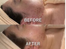 アリュメント(Allument)/【Before After】ニキビ