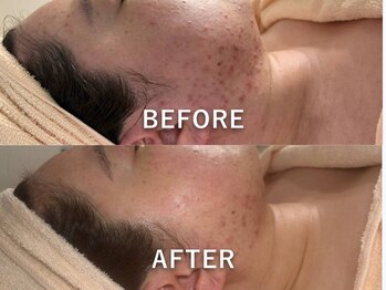 アリュメント(Allument)/【Before After】ニキビ