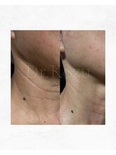 アルル 甲賀(ARuru)/1回でこの改善！