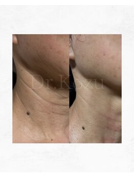 アルル 甲賀(ARuru)/1回でこの改善！