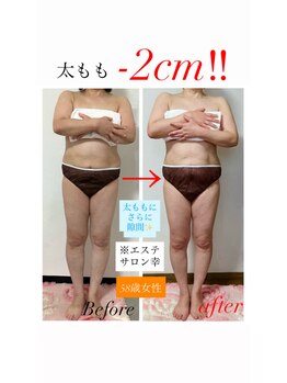 エステサロン 幸/50代 太もも -3cm