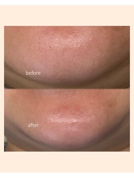 レア(Lea)/顎のザラつきも除去＊