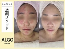 アルゴ 飯塚店(ALGO)/造顔メソッド