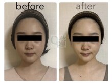 キュープ 小倉店(Qpu)/美顔器コース４回での変化