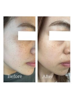 ギルドハナレ(GUILD HANARE)/【シミケアビフォーアフター】