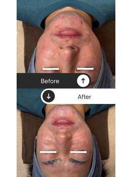 イチロクイチハチ(1618)/乾燥肌には鎮静と保湿