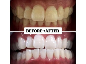 ホワイトニングサロン 豊中/Before&After美白ホワイトニング
