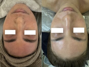 ミルジュ(MiLuJu)/AC/乾燥肌/4ヶ月ビフォアフ