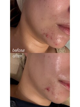 モア(more.)/肌荒れが気になる方へ