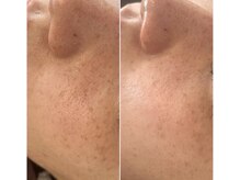 イロドリ(irodori)/ジュエリーピール♪