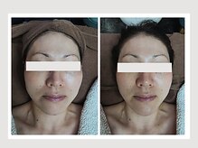 恵比寿脱毛 シーズ(She’s)/ソフトダーマ40代ビフォア