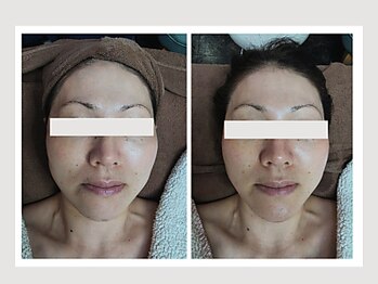 恵比寿脱毛 シーズ(She’s)/ソフトダーマ40代ビフォア