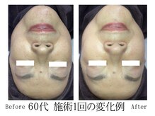 整(totonoi)/毛穴洗浄×炭酸導入