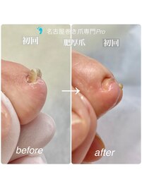 巻き爪が厚くなり反る爪