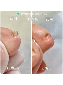 巻き爪が厚くなり反る爪