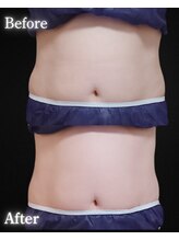 サンティエ(Santie)/痛みほぼ無し極上痩身※施術1回