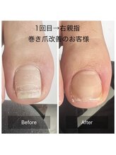 ヴィヴィアンヌ(VIVIANNE)/巻き爪改善