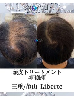 リベルテ(Liberte)/プロセル頭皮トリートメント