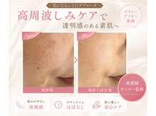 ヒカリ(Hikari)の雰囲気（事例多数シミケア／長岡京市・向日市・桂シミケア）