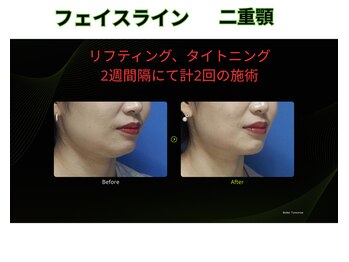 キートス(Kiitos)の写真/2.45GHzのマイクロ波/オンダシェイプで気になる二重あごも口周りのたるみも集中ケア。