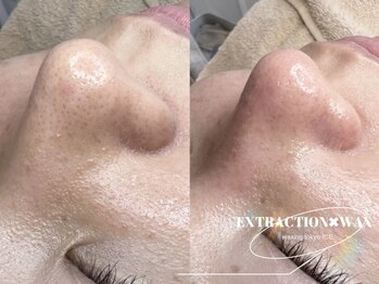 ワクシングトウキョウアイス 北千住西口店(waxing tokyo ice)/毛穴エクストラクション