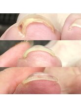 ヴィプラス(Vi+)/巻き爪改善