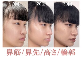 ラプリ 盛岡店(Raplit)/隆鼻＋輪郭矯正40分30回