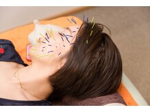 北梅田美容鍼灸院/【大阪/梅田】美容鍼灸