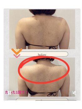 リシェル/お背中☆ビフォーアフター