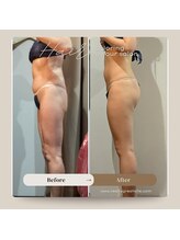 プラチナアース つくば店(Platinum earth)/【before&after】20回目★痩身