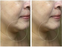 リフテグレース(LIFTE Grace)/光フェイシャル×テラボーラー