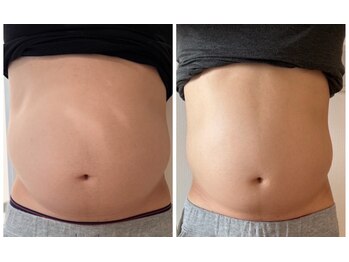 Kino Beauty Salon二子玉川店 ローマピンク/ホワイトラボ/脂肪冷却/シミ/メラニンケア/脂肪冷却