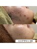 【大人ニキビ卒業】ハーブピーリング(剥離なし.保湿パック付)+肌分析