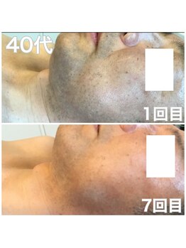 メンズ脱毛 ウィッシュ(Wish)/ヒゲ脱毛 早期脱毛　　7回目！