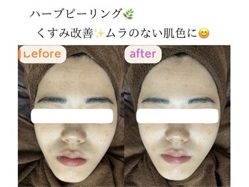 サクラ(SAKURA)/くすみ改善♪