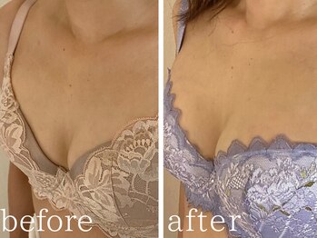 フォー(For...)/バストアップ◇1年経過後